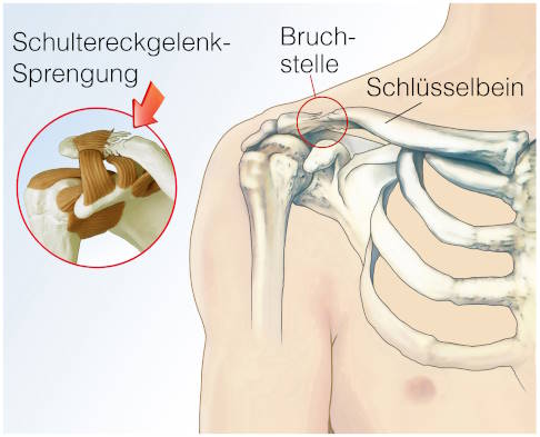 Die Verletzung des Schultereckgelenks entsteht häufig beim Sport. © ImageSine, Adobe Schultereckgelenksprengung