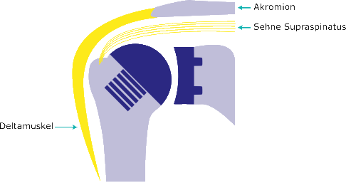 Es erfolgt ein knochensparender Oberarmkopfersatz mit Ersatz der Gelenkfläche des Glenoids. Die eigentliche Anatomie des Gelenkes wird beibehalten.