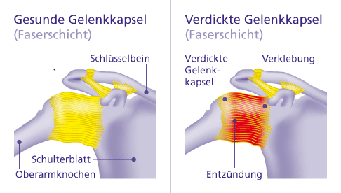 Op naht entzündete Naht und