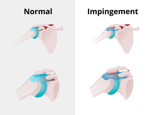 Impingement-Syndrom