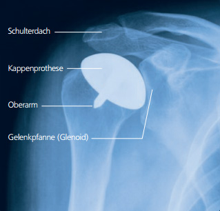 Röntgenbild der Hemiprothese (Kappenprothese) der Schulter