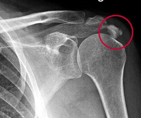 Kalkschulter im Röntgenbild