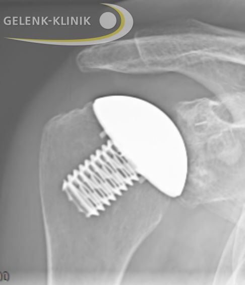 Knochensparender Ersatz der Gelenkflächen von Oberarmkopf und Gelenkpfanne mithilfe einer Kappenprothese. Dieses Modell der Schulterprothese erhält die ursprüngliche Anatomie der Schulter. Die Glenoidkomponente aus Kunststoff ist im Röntgen kaum sichtbar. © Gelenk-Klinik Kappenprothese