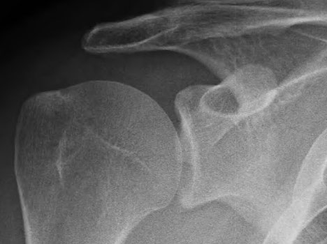 Röntgenbild einer gesunden Schulter