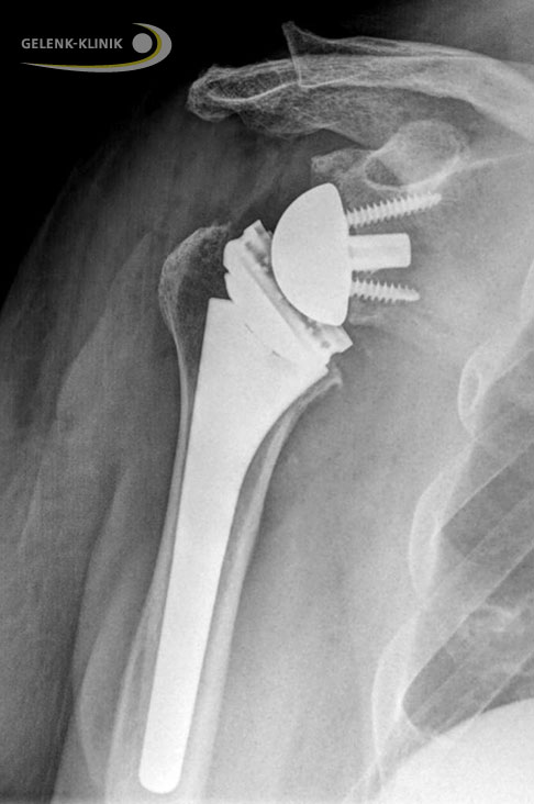 Röntgen inverse Schulterprothese