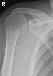 Рентгенограмма пациента с полным разрывом вращательной манжеты. Плечевая кость пациента касается акромиона (импинджмент-синдром). © Gelenk-Klinik