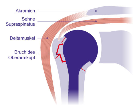 Schema Hemiprothese