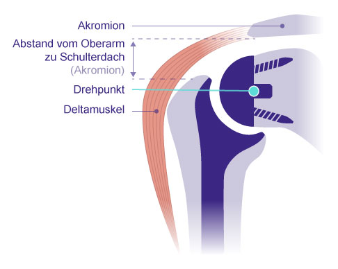 Künstliches Schultergelenk « Schulterchirurgie « Leistungsspektrum