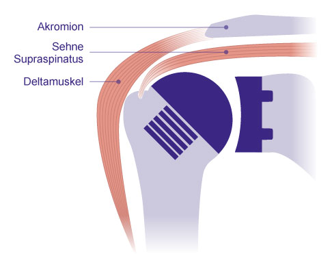 Schematische Darstellung einer Kappenprothese. Sie besteht aus zwei Komponenten: einer zementfrei fixierten Hohlschraube im Oberarmkopf und einer Pfannenkomponente aus Kunststoff. Die Sehne des Musculus supraspinatus und der Deltamuskel werden in ihrer anatomischen Lage nicht verändert. Der Drehpunkt des Schultergelenks bleibt wie der Abstand zwischen Oberarm und Schulterdach (Akromion) unverändert. © Gelenk-Klinik Schema Kappenprothese