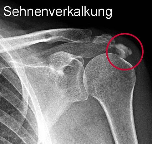 Schulterschmerzen Ursachen Ubungen Behandlung Gelenk Klinik De