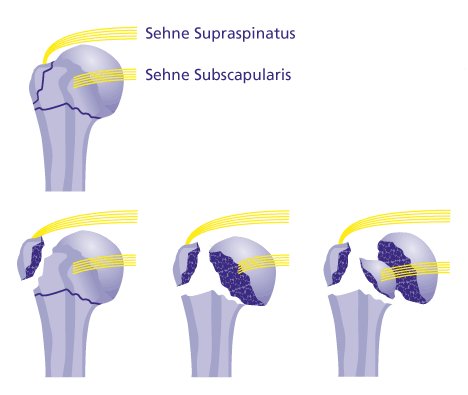 Proximale Humerusfraktur: Veranschaulichung von Bruchfragmenten und Sehnen.