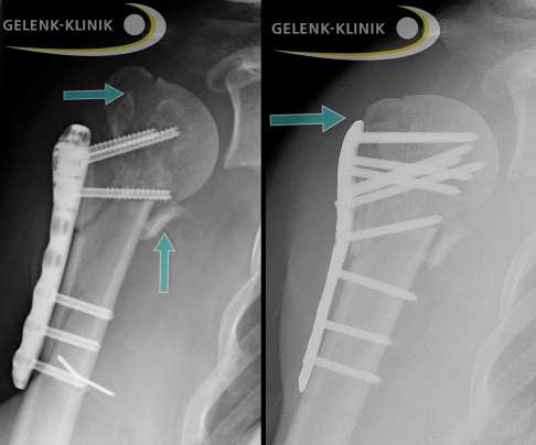 Links: Unzureichende Reposition einer 4-Teile-Fraktur am Oberarmkopf. Nur zwei Schrauben fassen die Kalotte (Kopf des Oberarmknochens). Die beiden Tubercula (knöcherne Vorsprünge) sind unzureichend reponiert (blaue Pfeile). Das Kalottenfragment ist zusätzlich verkippt. Rechts: Nach operativer Korrektur befinden sich Kalotte und Tubercula in anatomisch korrekter Position. Sie sind zusätzlich durch eine Plattenosteosynthese stabilisiert.