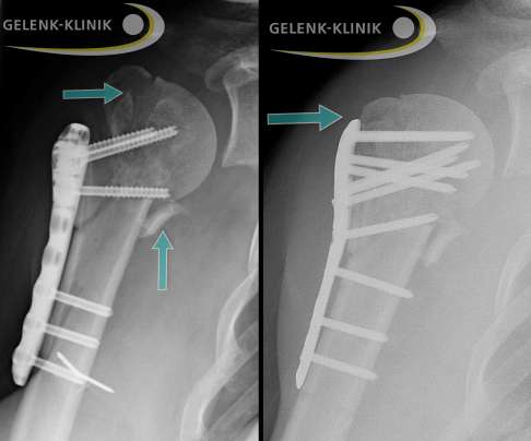 Humeruskopffraktur Bruch Des Oberarmkopfes Gelenk Klinik De