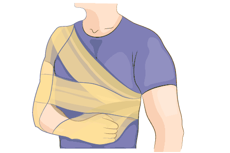 Darstellung des Desault-Verbands oder auch Achsel-Schulter-Ellenbogen-Verbands, der einer Ruhigstellung von Schulter und Oberarm dient.