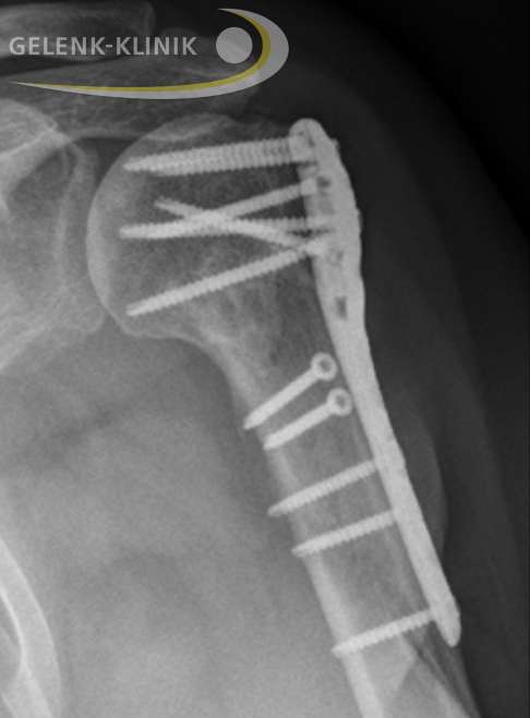 Beispiel einer erfolgreichen Osteosynthese im Röntgenbild. Der Oberarm (Humerus) ist mehrfach im Kopfbereich gebrochen. Die Knochenfragmente wurden in einem operativen Verfahren mithilfe von Schrauben und Platten anatomisch korrekt reponiert.