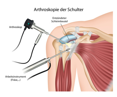 Subakromiale Dekompression bei Schulter-Impingement