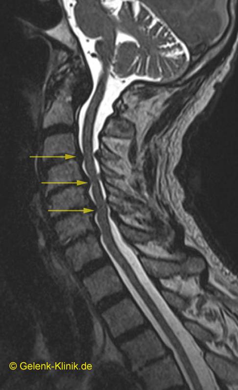 Spinalkanalstenose Verengung Des Ruckenmarks Der Wirbelsaule Gelenk Klinik De