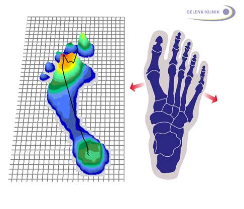 Anatomie und podometrische Untersuchung des Spreizfußes: Eine Platte zeichnet die Verteilung des Körpergewichts, das beim Abrollen auf der Fußsohle lastet, auf und stellt dies über eine Computergrafik dar. An den roten Stellen ist die Gewichtsbelastung besonders hoch, die blauen Stellen haben eine niedrige Gewichtsbelastung. Das Bild zeigt die durchschnittliche Verteilung der Druckbelastung während eines Schrittes. Die Untersuchung wird nicht im Stand, sondern während des Schrittes - also dynamisch – ausgewertet. © Gelenk- Klinik.de Anatomie und podometrische Untersuchung des Spreizfußes: Eine Platte zeichnet die Verteilung des Körpergewichts, das beim Abrollen auf der Fußsohle lastet, auf und stellt dies über eine Computergrafik dar. An den roten Stellen ist die Gewichtsbelastung besonders hoch, die blauen Stellen haben eine niedrige Gewichtsbelastung. Das Bild zeigt die durchschnittliche Verteilung der Druckbelastung während eines Schrittes. Die Untersuchung wird nicht im Stand, sondern während des Schrittes - also dynamisch – ausgewertet. © Gelenk- Klinik.de