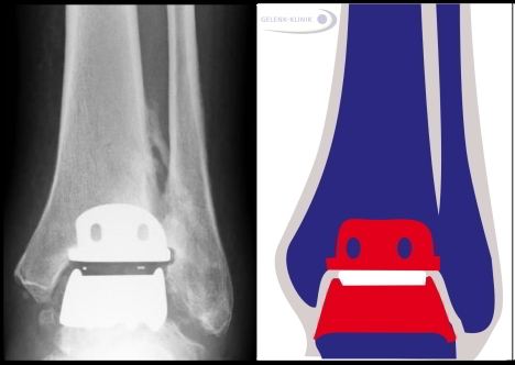 Moderne Sprunggelenksprothese im Roentgenbild seitlich