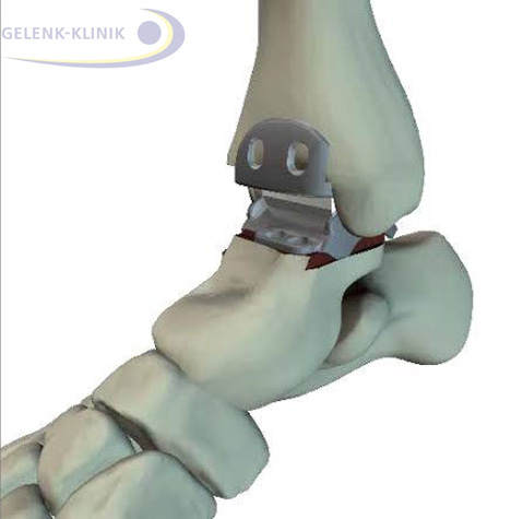 A modern 3rd generation Hintegra ankle prosthesis consists of three components. Between the articular surfaces is the mobile plastic (PE) core. As a result the prosthesis is mobile and supports the natural pattern of gait as it is coordinated by the ligaments of the ankle joint.