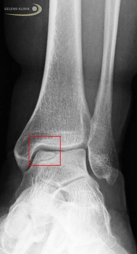 osteochondritis dissecans sprunggelenk