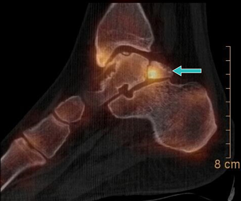 Голеностопный сустав с трёхгранной костью или переломом отростков Стиеда, удлинённое разрастание заднего отростка надпяточной кости. © Gelenk-Klinik