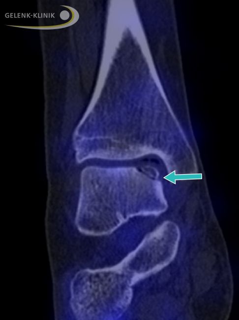 Визуализационное изображение рассекающего остеохондрита с некротизированной областью на внутренней стороне таранной кости. © Gelenk-Klinik