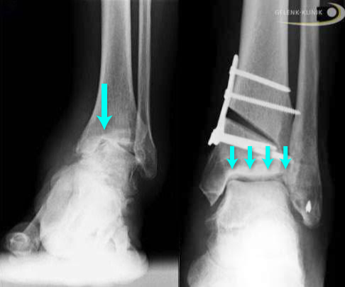 Darstellung einer erfolgreich druchgeführten Behandlung (Umstellungsosteotomie) am Sprunggelenk