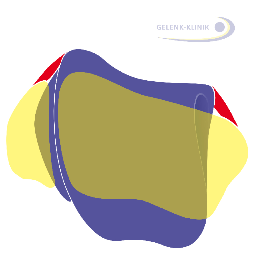 The position of the talus (purple: the ankle bone, yellow: calf bone and shin) is impacted by the surrounding ligaments of the ankle.