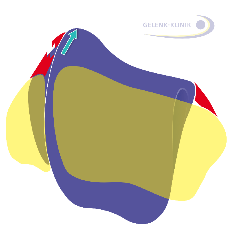 A rupture of the lateral ligament destabilises the talus (ankle bone) and results in a raised lateral (outside) talus. (purple: the ankle bone, yellow: calf bone and shin)