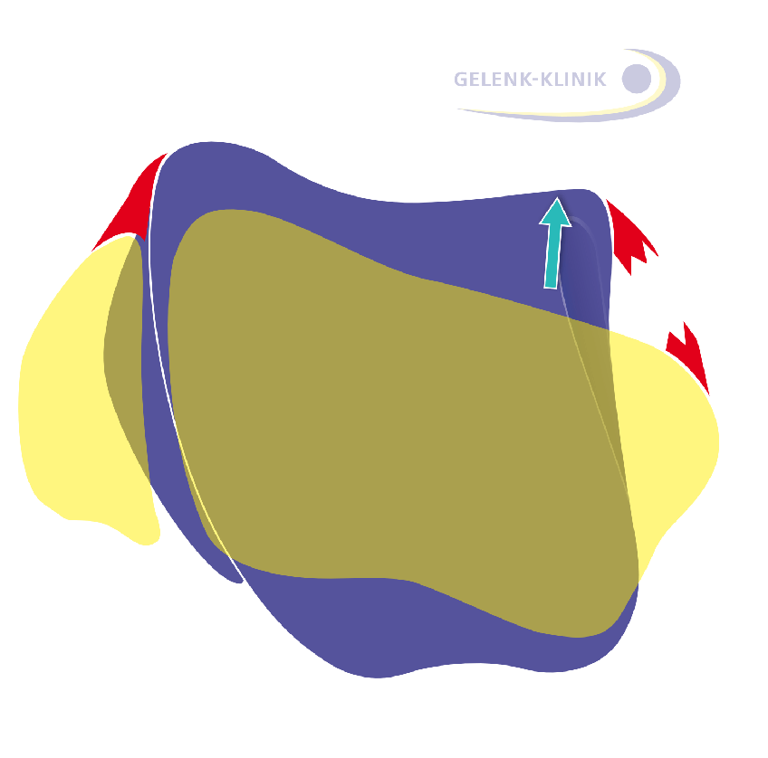 A rupture of the medial ligament destabilises the talus and results in a raised medial (inside) talus.