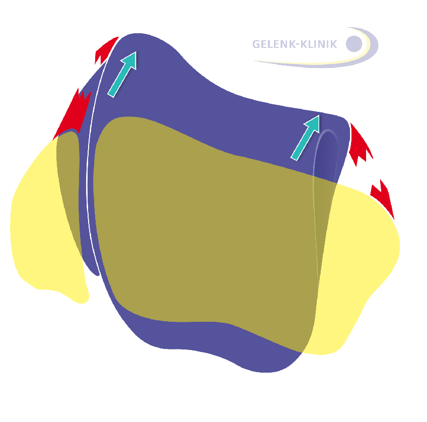 Simultaneous rupture of the medial and lateral ligaments changes the biomechanics of the ankle bone (talus) the most.