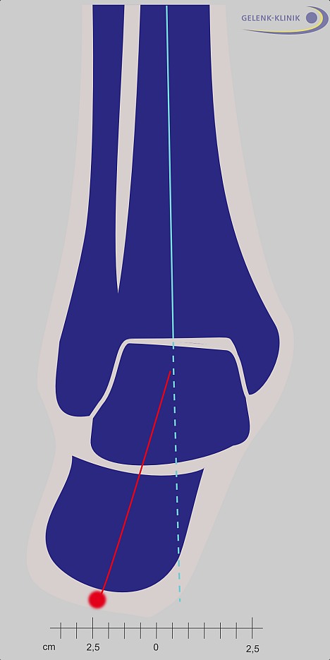 The valgus position of the heel bone (X-position or inward buckling) is a deformity of the ankle. This can become ankle osteoarthritis. The deformity has to be corrected prior to implanting an ankle prosthesis to assure proper weight distribution. 