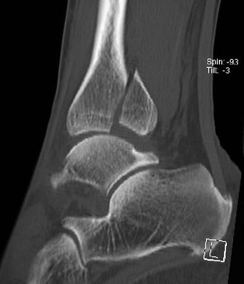 Wie gips lange gebrochen sprunggelenk Bei welchen