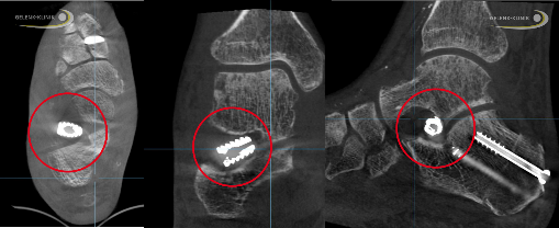 Arthrorise im Röntgenbild