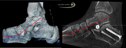 Aufrichtung des Fußlängsgewölbes durch ein Implantat