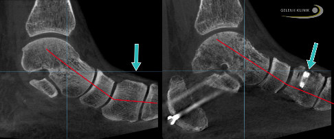 Aufrichtung des Fußlängsgewölbes durch Implantation eines Titankeils in das innenliegende Keilbein (mediales Keilbein)