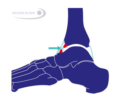 File:Dorsalextension und Plantarflexion.PNG - Wikimedia Commons