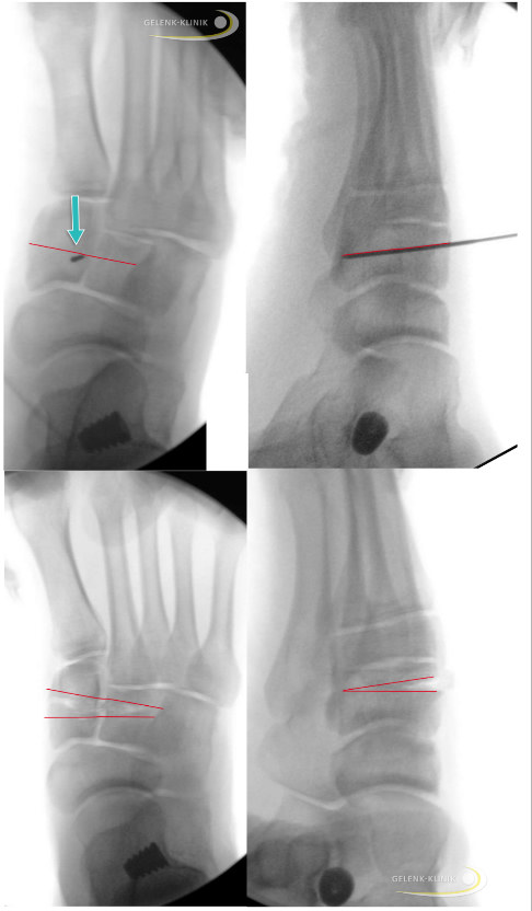 Intraoperative Kontrolle bei Cotton-Osteotomie mit Kirschner-Draht