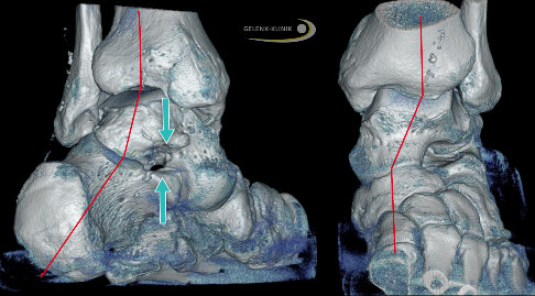 Knick-Senkfuß mit Taluskopf-Verschiebung und Fersenfehlstellung
