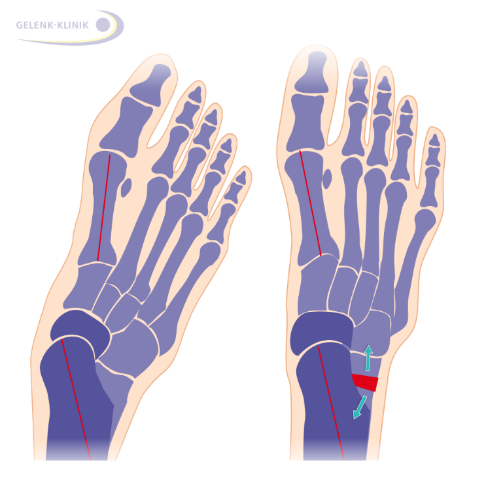 Knick-Senkfuß mit geschwächter Tibialis-posterior-Sehne von oben