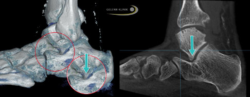 Talocalcaneares Impingement beim Knick-Senkfuß im CT und 3D
