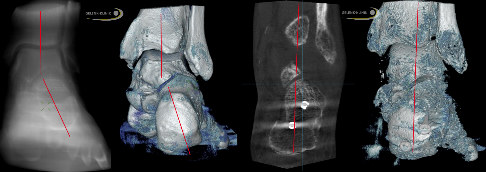 Knickfuß: Rückfuß-Achse vor und nach OP im CT und 3D
