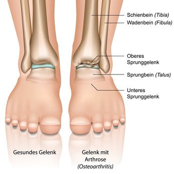 Arthrose Fuß übungen