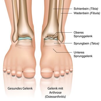 Durch eine Schädigung des Gelenkknorpels (z. B. durch Fehlbelastung) entsteht eine Sprunggelenksarthrose im oberen Sprunggelenk (OSG) © bilderzwerg, Fotolia. Knorpelschaden im Sprunggelenk