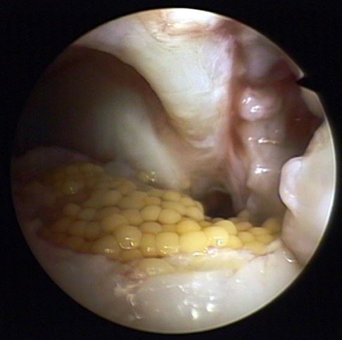 Knorpeltransplantation bei Osteochondrosis dissecans im Sprunggelenk