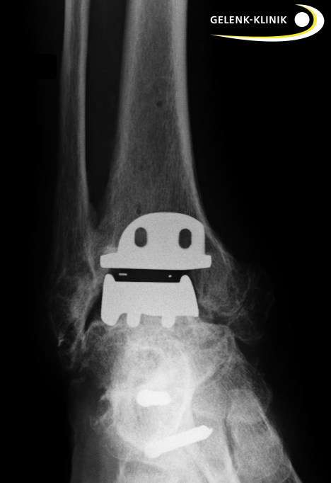 Eine Sprunggelenksprothese bei Fehlstellung im Gelenk ist erst nach erfolgreicher Osteotomie (Knochenumstellung und Begradigung der Beinachse) möglich. © Gelenk-Klinik.de Sprunggelenk nach Osteotomie (Knochenumstellung)