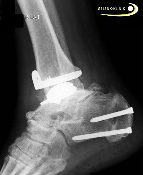 Sprunggelenksprothese nach Begradigung des Sprunggelenks seitlich. © Gelenk-Klinik.de Sprunggelenk nach Begradigung der Sprunggelenksachse