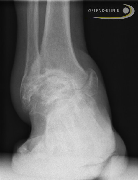 X-ray image of a severe case of ankle arthritis. Extreme deformity of the ankle prevents a proper ankle prosthesis.