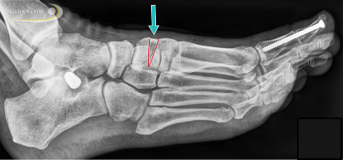 Röntgenbild nach Cotton-Osteotomie mit knöchernem Keil